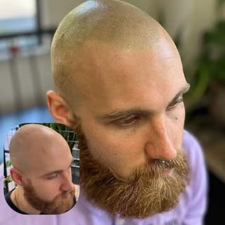 Scalp Micropigmentation aka S.M.P

⭐️BLACK FRIDAY SPECIAL - $250 OFF Hair Restoration

Existing Clie