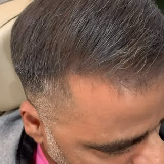 Alopecia Androgenética tem tratamento, sim!

Veja a incrível evolução desse paciente com um protocol