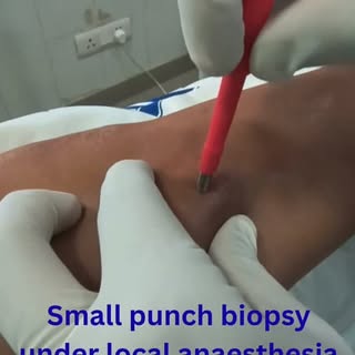 Not every skin condition can be diagnosed by looking at it alone. 🩺

A skin punch biopsy is a simpl