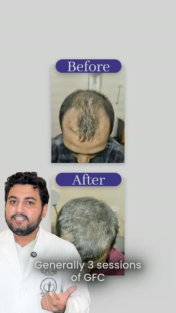 [GFC vs PRP — from a medical lens]

Both PRP (Platelet-Rich Plasma) and GFC (Growth Factor Concentra