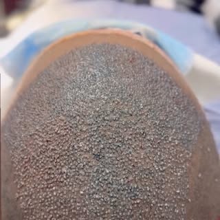 HAIR TRANSPLANTATION ✨

Regain your hair. Restore your confidence.

✔ Natural-looking hairline
✔ Use