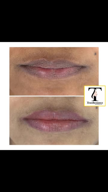 Wake Up to Naturally Beautiful Lips!✨

Thinking about giving your lips a more defined, fresh & natur