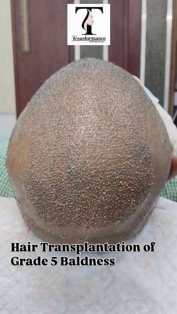 Hair Transplantation of Grade 5 Baldness Case with Complete Coverage…

Contact - 9959721694 / 995982