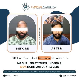 Behold the power of FUE technology!
Witness the incredible journey of our satisfied patient, who exp