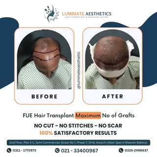 Marvel at the magic of FUE technology!

Delve into the remarkable journey of our delighted patient, 