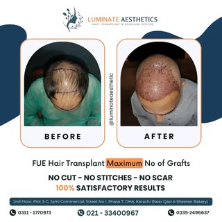 Marvel at the magic of FUE technology!
Delve into the remarkable journey of our delighted patient, w