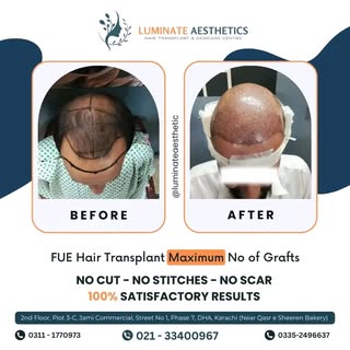 Marvel at the magic of FUE technology!
Delve into the remarkable journey of our delighted patient, w