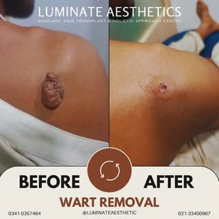 Say goodbye to unwanted warts! ✨
Our advanced wart removal treatment ensures smooth, clear skin with