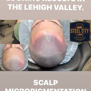 Receding hairline correction! Complete transformation of the frontal portion of the hairline. Rednes