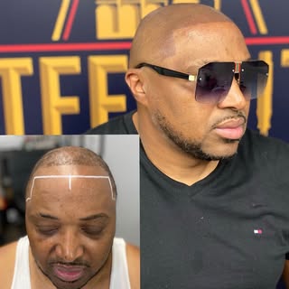 First session complete! We did overhaul of the front hairline, reconstructed the sidewalls. Does he 