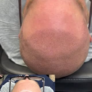 First session done ✅ complete overhaul front to back. Nice natural results. Book your free consultat