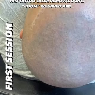 HE HAD TWO BAD SMP PROCEDURES DONE, FUE DONE. CROOKED HARD HAIRLINE HE WANTED SOFTENED UP. GOT HIM T