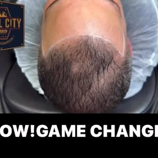 Scalp Micropigmentation can create an illusion of thicker hair by creating density. The contrast bet