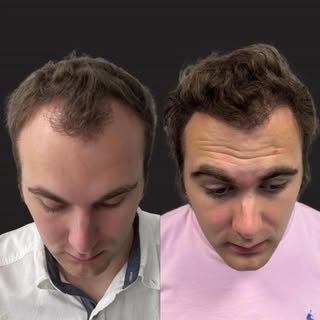 Before and only 7 months after 1 treatment session with Bio Enhanced Follicular Unit Extraction (Bio