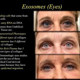 Exosomes injections for eye bags see 3day results!  #grecomedicalgroup #eyebags #nonsurgical