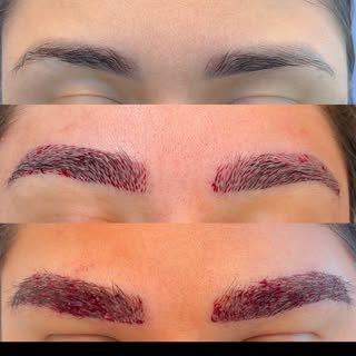 Eyebrow Transplantation- Our patient had previous microblading performed, however wanted a more natu