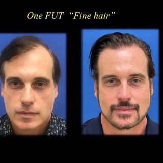 One Session Bio Follicular Unit Transplant