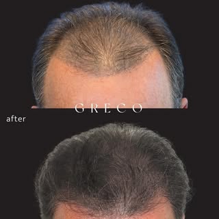 Before and 11 months after Bio Enhanced Follicular Unit Transplantation (Bio-FUT). Bio-FUT utilizes 