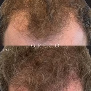 Amazing FUE results…Before and only 7 months after 1 treatment session with Bio Enhanced Follicular 