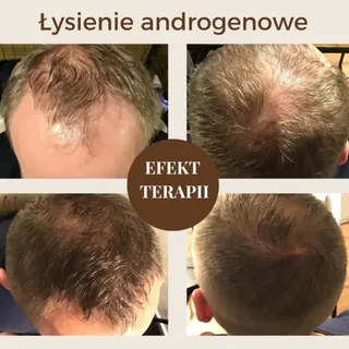 ✨ Historia Bartka – walka z łysieniem typu męskiego

Bartek to jeden z moich bardziej wymagających p