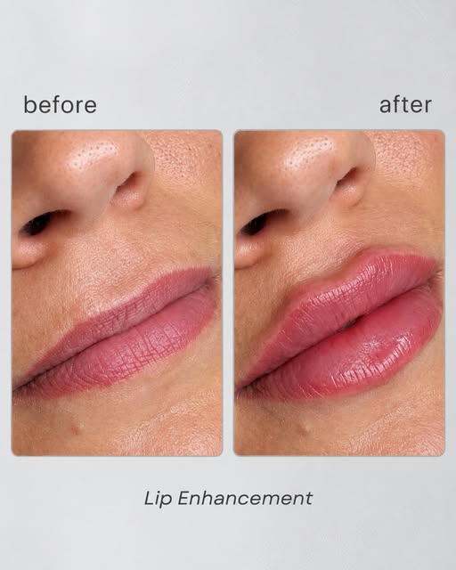 SUBTLE ENHANCEMENT. BEAUTIFUL IMPACT.

Lip enhancement isn’t about changing your look—it’s about ref