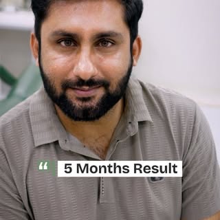 Hair Transplant Results of Patient at Dot Clinics with combination of FUE + DHI (World's Latest & Be