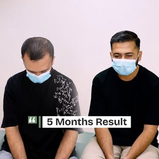 Hair Transplant Results of Patient at Dot Clinics. FUE + DHI (World's Latest & Best) available in La