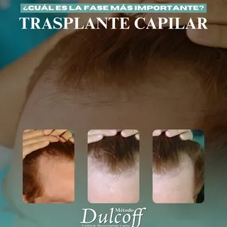 ¿Cuál es la fase más importante de un Trasplante Capilar? 👇

Si bien todas las fases son importante