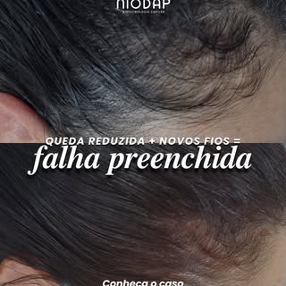 Se o seu cabelo está afinando, caindo e começando a abrir falhas… isso tende a piorar se você não tr
