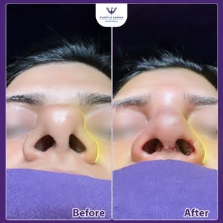 ✨ Another Successful Transformation! 
Rhinoplasty done successfully by the expert hands of Dr. Nites