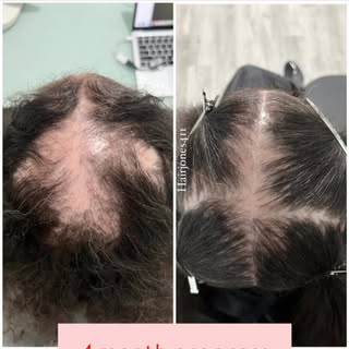 Incredible Progress in Just 4 Months! 

Our amazing client has been on a journey battling Lichen Pla