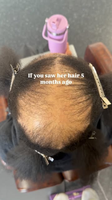 Progress is one of the most beautiful things 

Comment “READY” to schedule your VitaScalp therapy w:
