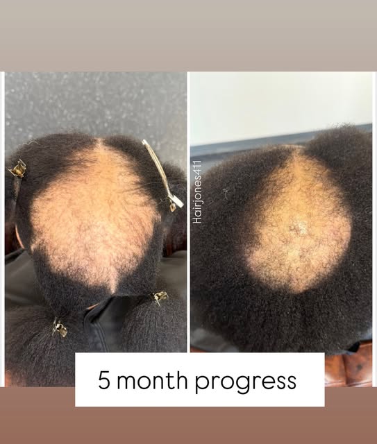 Over 12 years of HAIR LOSS 

5 months of progress. 

Jumpstart your hair growth & DENSITY ! Let’s sc