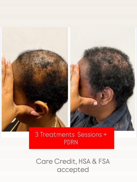 15 + years of hair loss with no one to help !

This is such a common story. But now there’s help and