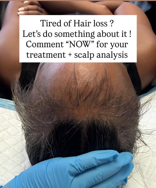 Is your HAIRLINE thinning/ receding? 

Let’s reverse it now 

Comment “NOW” for your Scalp analysis 
