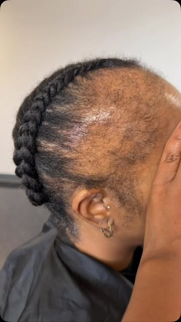 Are you experiencing Traction hair loss ? 

Comment “VITA” To start your journey with a scalp analys