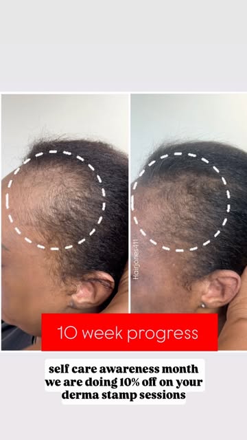 Comment “STAMP” for the 🔗 

#hairjones411 #hairlosstreatment #ccca #trichologist #hairloss
