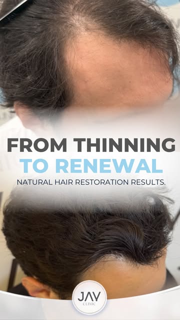 Real results. Thoughtful planning. A hairline designed to look natural—not simply lower.

This hair 