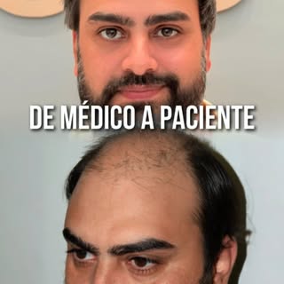 De médico a paciente: a minha experiência real com o Transplante Capilar. 👨‍⚕️🤝

Muitos homens me 
