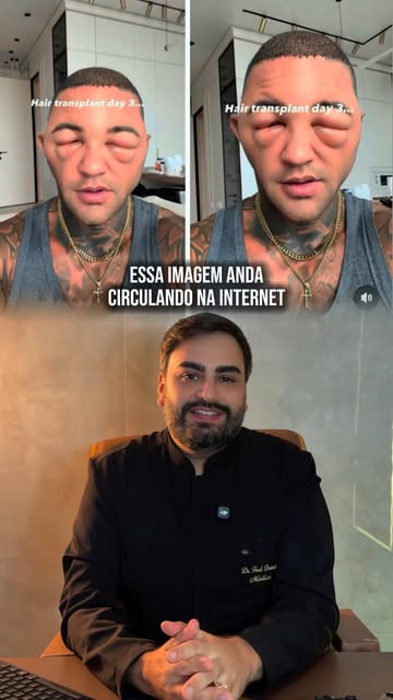 O rosto sempre incha após o transplante capilar? ⚜️

Imagens como essa assustam, mas a explicação mé