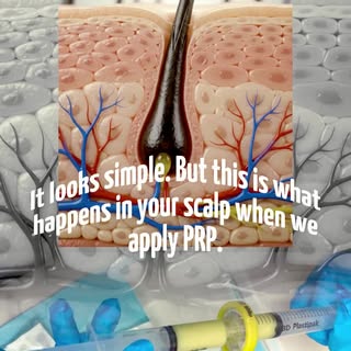 PRP uses the patient's own blood, concentrated with growth factors, to strengthen the follicle.

Boo