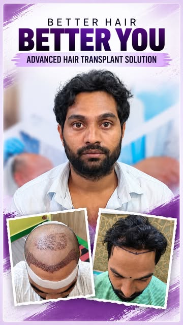 REAL HAIR TRANSPLANT TRANSFORMATION ✨

A journey from a receding hairline to a fuller, natural-looki