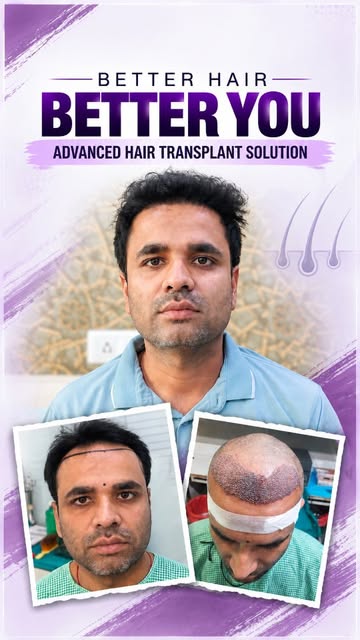 A carefully planned hair transplant can help restore the hairline and create a more natural, balance