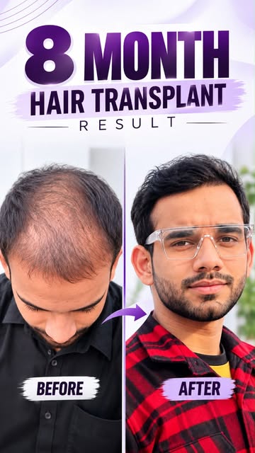 Transform your look with an advanced Hair Transplant Solution designed for a natural hairline, safe 
