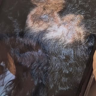 A alopecia química é a queda capilar provocada pelo uso indevido ou agressivo de produtos químicos, 