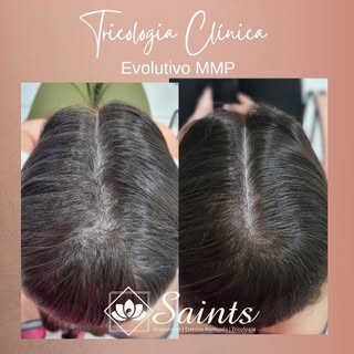 Mais um evolutivo que amamos acompanhar de alopecia queda de cabelo. Evolutivo de 4 meses (6 sessões
