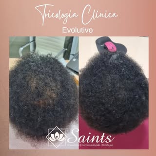 O Corte químico e alopecia de tração podem causar danos severos aos cabelos e ao couro cabeludo. Alé