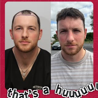 Swipe to see what’s possible in 7 months🤩✨

This transformation was achieved using the Sapphire FUE