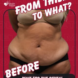 Tummy Tuck & Liposuction ✨

A more defined silhouette starts with the right approach.
Tummy Tuck hel