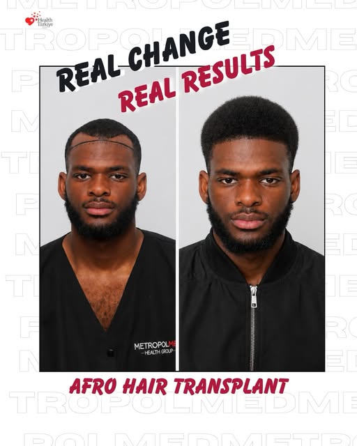 Swipe to see the transformation from 6 months to 1 year 🤩✨

This Afro hair transplant journey shows